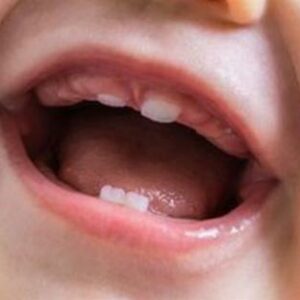 20+ Hình ảnh lợi trẻ sắp mọc răng hàm và răng cửa dễ nhận biết