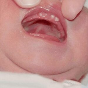 Hình ảnh nanh sữa ở trẻ sơ sinh và cách điều trị nanh sữa
